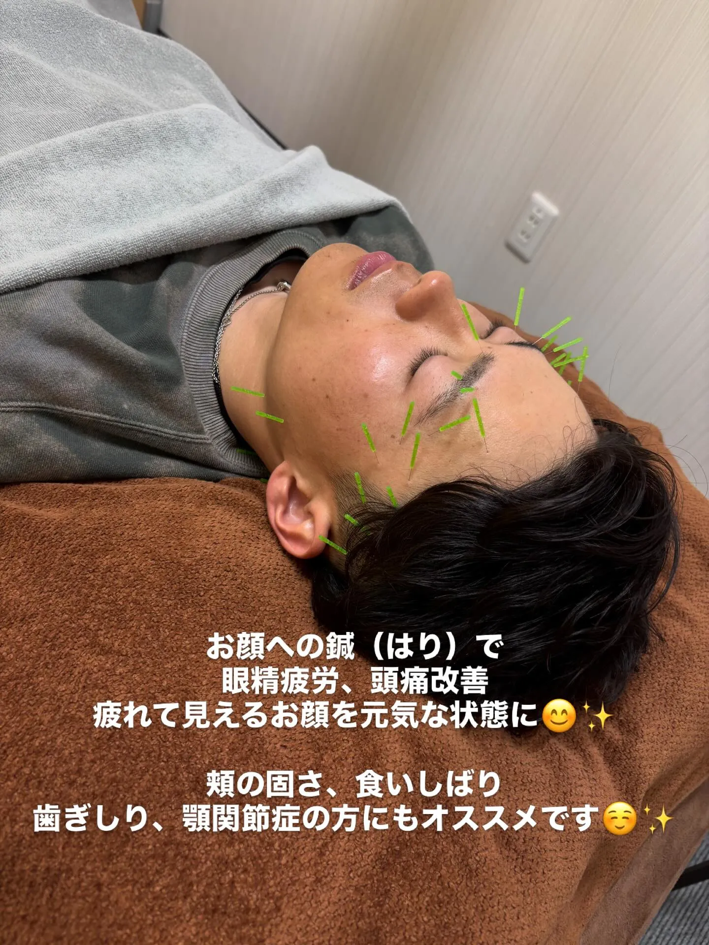 お顔への鍼(はり)は美容だけじゃありません!